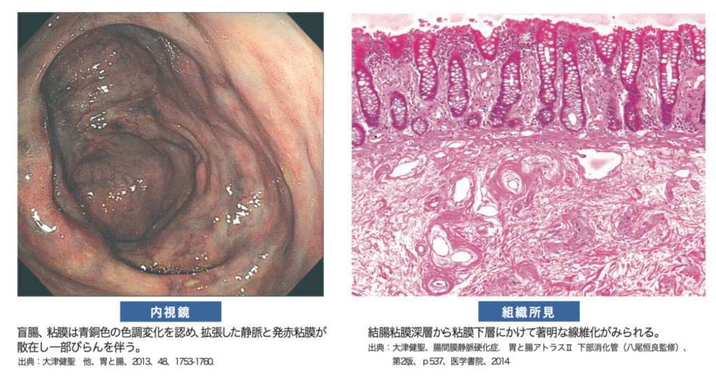 静脈 腸 症 膜 間 硬化 gastropedia（ガストロペディア） 消化器にかかわる医療関係者のために