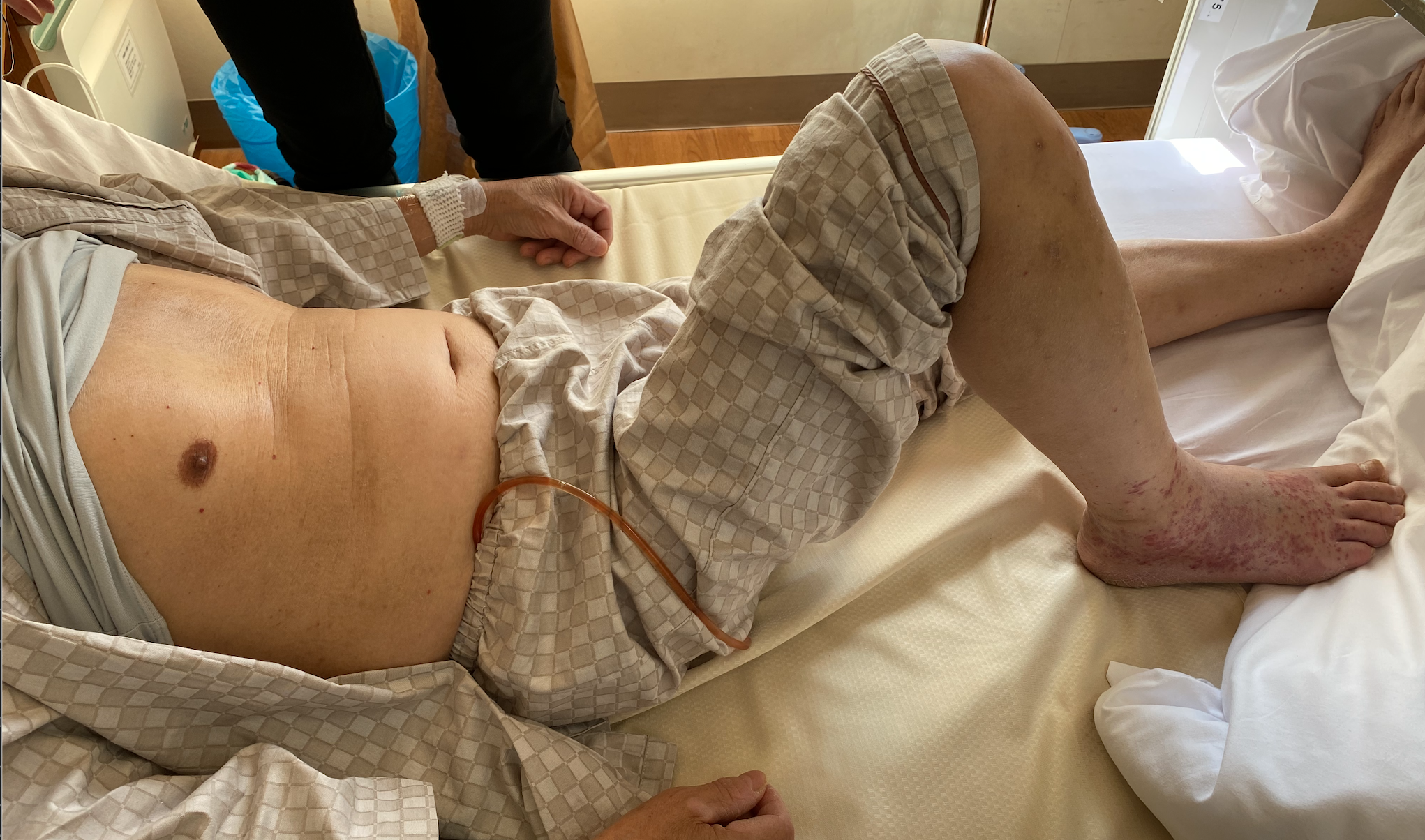 腸腰筋膿瘍 Lliopsoas Abscess ある内科医のまとめ 腸腰筋膿瘍 Lliopsoas Abscess ある内科医のまとめ