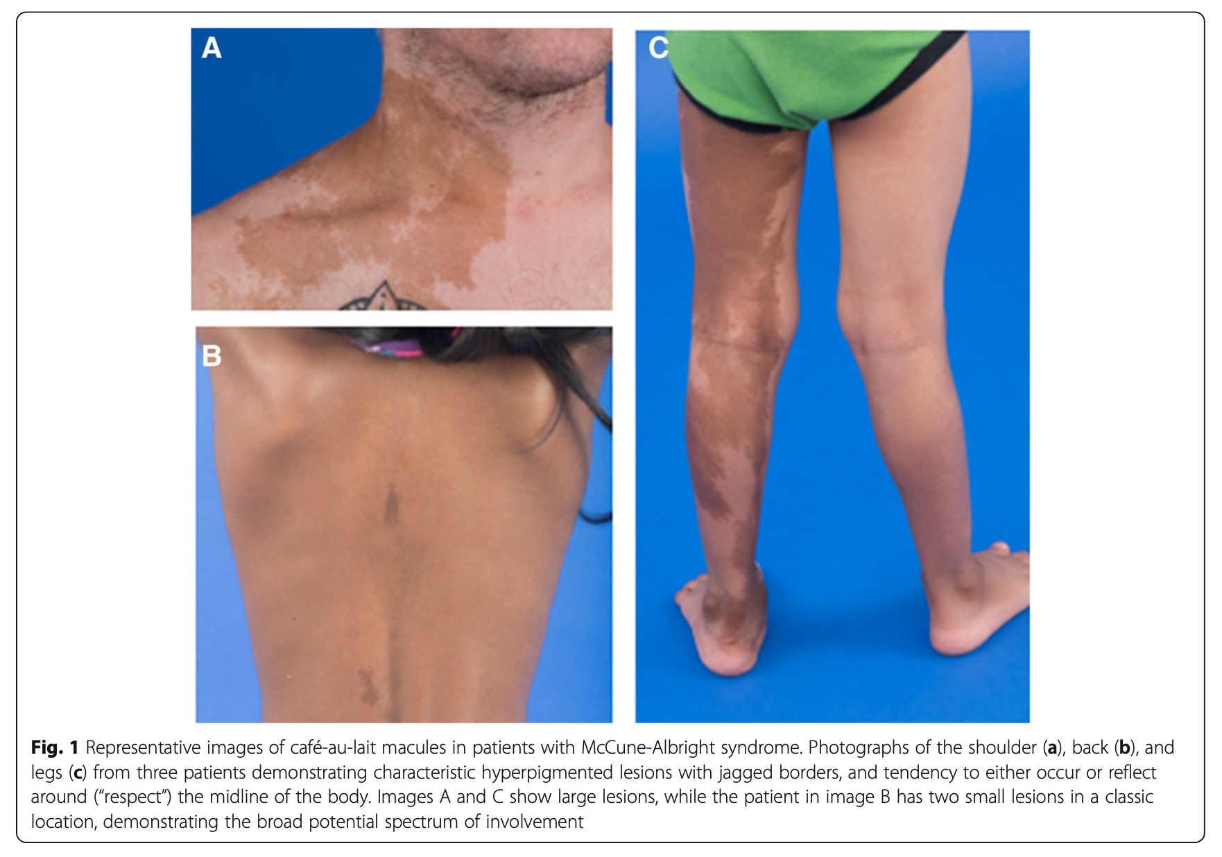 McCuneu00 Albright Syndrome｜ある内科医のまとめ