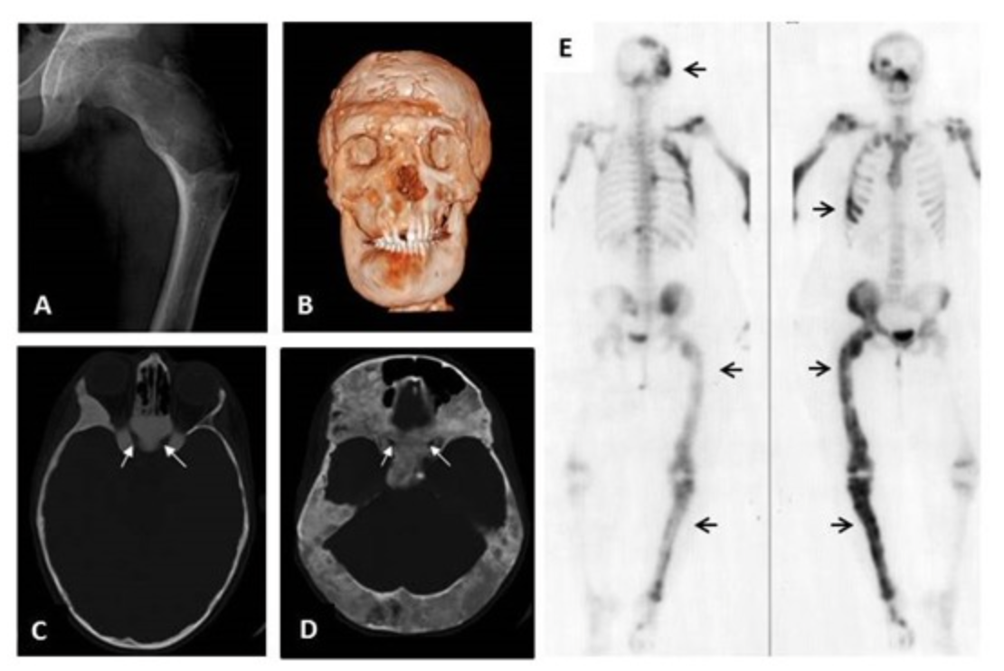 McCune Albright Syndrome｜ある内科医のまとめ